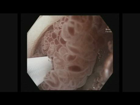 Résection Mucosale Endoscopique Sous-Marine (UEMR)