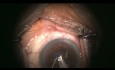 Chirurgie Complexe de la Cataracte avec Surprise de Zonule Manquante