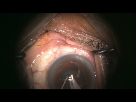 Chirurgie Complexe de la Cataracte avec Surprise de Zonule Manquante