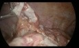 Occlusion intestinale due à une Appendicite Aiguë