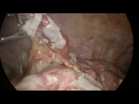 Occlusion intestinale due à une Appendicite Aiguë