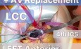 Pontage Aorto-Coronarien + Remplacement Valvulaire Aortique par Thoracotomie Antérieure Gauche