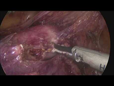 Hystérectomie Laparoscopique Totale + Curage Ganglionnaire Complet