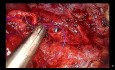 Résection en manchon de la bronche principale droite - chirurgie thoracique vidéo-assistée (CTVA) à l'incision unique