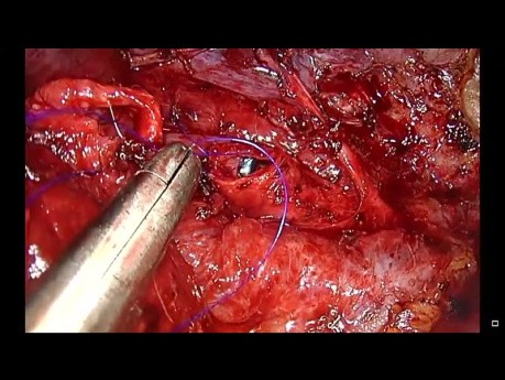 Résection en manchon de la bronche principale droite - chirurgie thoracique vidéo-assistée (CTVA) à l'incision unique