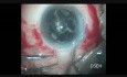 Rhexis oval aide à éliminer la cataracte noire