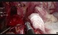 Cardiomyotomie de Heller Laparoscopique pour Achalasie 