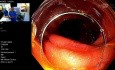 Résection Muqueuse Endoscopique pour LST du Côlon Droit