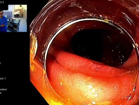 Résection Muqueuse Endoscopique pour LST du Côlon Droit