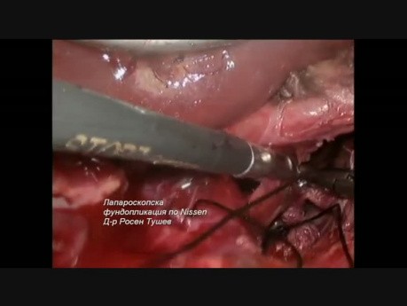 Fundoplicature Laparoscopique de Nissen (RGO)