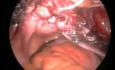 Sacrocolpopexie laparoscopique