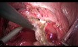 Chirurgie laparoscopique de l'endométriose vésicale