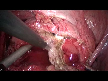Chirurgie laparoscopique de l'endométriose vésicale