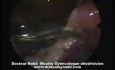 Sterilisation Tubaire Coelioscopique