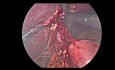 Réopération de l'anastomose gastro-jéjunale dans un bypass gastrique de Roux en Y