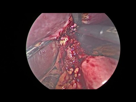 Réopération de l'anastomose gastro-jéjunale dans un bypass gastrique de Roux en Y