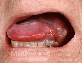 Carcinome épidermoïde de la langue