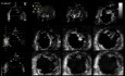 La non-compaction ventriculaire gauche - L'échocardiographie 3D, vidéo n ° 1