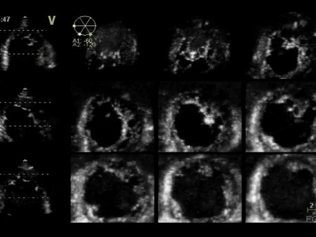 La non-compaction ventriculaire gauche - L'échocardiographie 3D, vidéo n ° 1