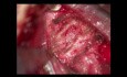 Fracture du rachis cervical