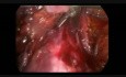 Cancer du col de l'utérus: hystérectomie totale par voie laparoscopique + lymphadénectomie pelvienne