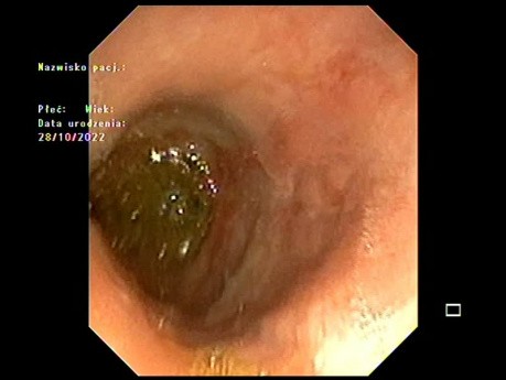 Lésion Oesophagienne - Tumeur Débutante ou ..? 