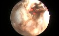 Prostatectomie au laser Greenlight HPS - Saignement