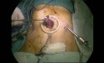 Gastrectomie totale par voie laparoscopique