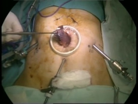 Gastrectomie totale par voie laparoscopique