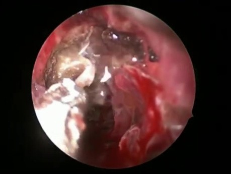 Réparation des Fuites de LCR – Approche Endoscopique