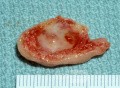 Spécimen opératoire de concha bullosa