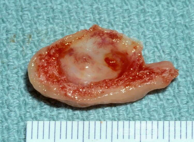 Spécimen opératoire de concha bullosa