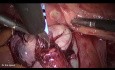 Réimplantation de l'uretère dans la vessie par cœlioscopie - endométriose urétérale