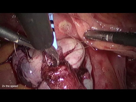 Réimplantation de l'uretère dans la vessie par cœlioscopie - endométriose urétérale