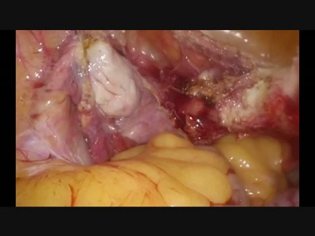 Hystérectomie Préc. 2 ISCS Utérus