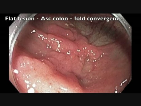 Côlon: Résection Muqueuse Endoscopique compliquée d'une perforation - partie 1