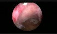 Morcellement Hystéroscopique d'un Fibrome Sous-Muqueux