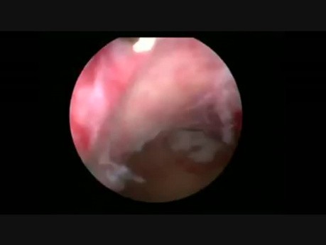 Morcellement Hystéroscopique d'un Fibrome Sous-Muqueux
