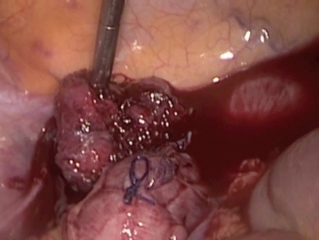 Suture laparoscopique du prolapsus rectal