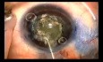 Capsulotomie par Fugo Blade dans un petit œil