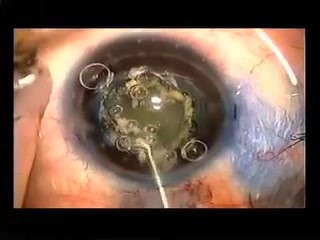 Capsulotomie par Fugo Blade dans un petit œil