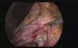 Duodénojéjunostomie par voie laparoscopique en raison du syndrome de l'artère mésentérique supérieure
