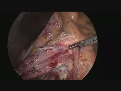 Duodénojéjunostomie par voie laparoscopique en raison du syndrome de l'artère mésentérique supérieure