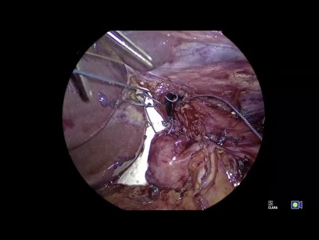 Application - Tutoriel Fundoplicature Géométrie, Chapitre 10 - Création d'une fundoplicature à 270°