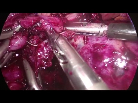 Pancréatectomie distale pour la tumeur kystique mucineuse du pancréas par laparoscopie avec conservation de la rate