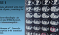 Efficacy of Minimally Invasive Surgery in Bowel Intussusception