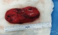 Tumeur Lipomateuse Atypique (Liposarcome Différencié)