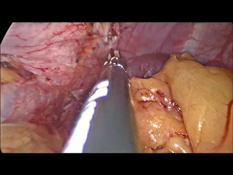 Sleeve gastrectomie laparoscopique