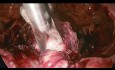 Grossesse extra-utérine cervicale gérée par chirurgie laproscopique