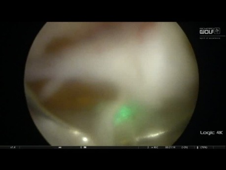 Énucléation endoscopique anatomique de la prostate pour obstruction bénigne de la prostate - ThuLEP pulsé